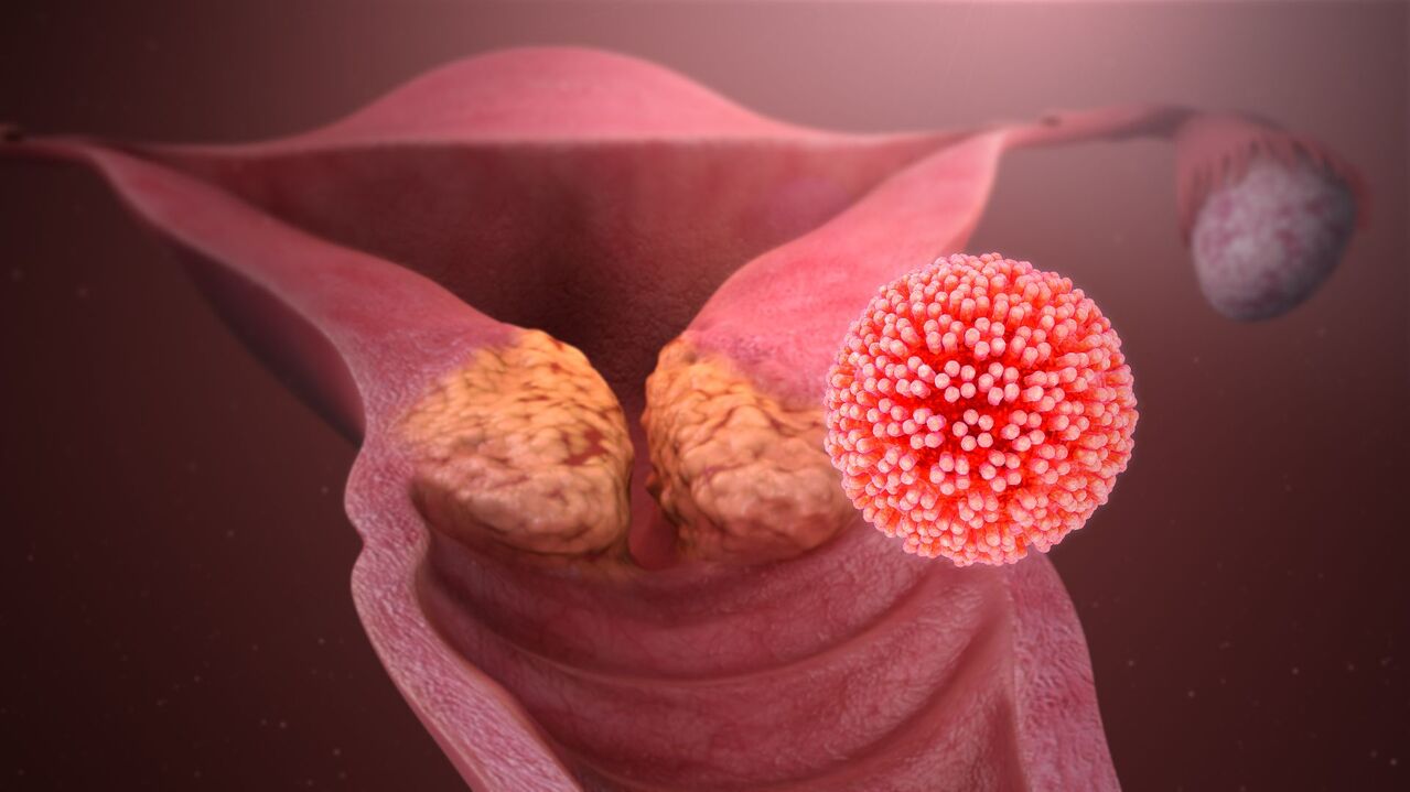 Virus del papiloma humano en el cuerpo. 